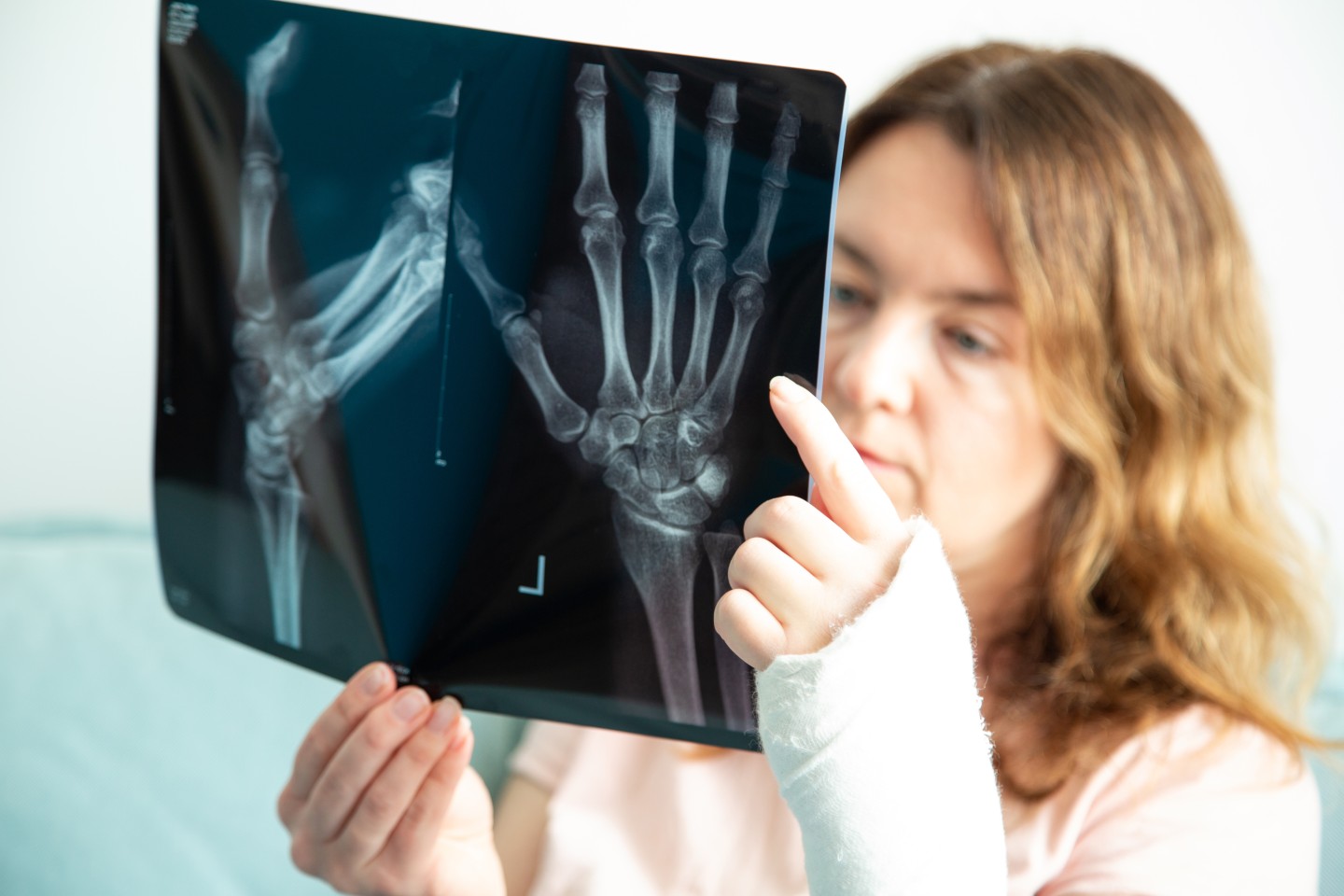 Broken Bones Injuries